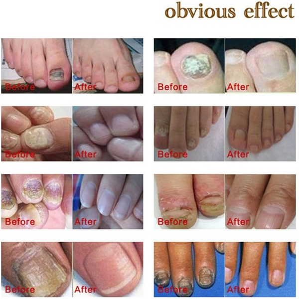 Varisi Toe Finger Healthy Nail Fungus Cure Antifungal Fungal Lotion